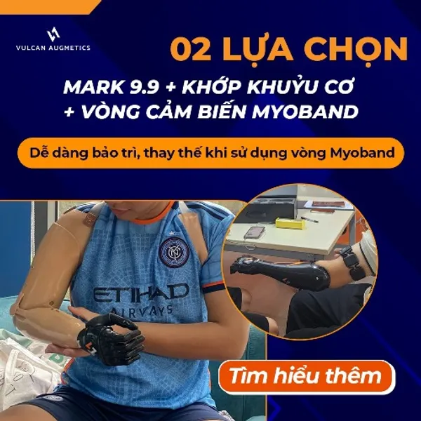 Thông tin chung về tay giả trên khuỷu 